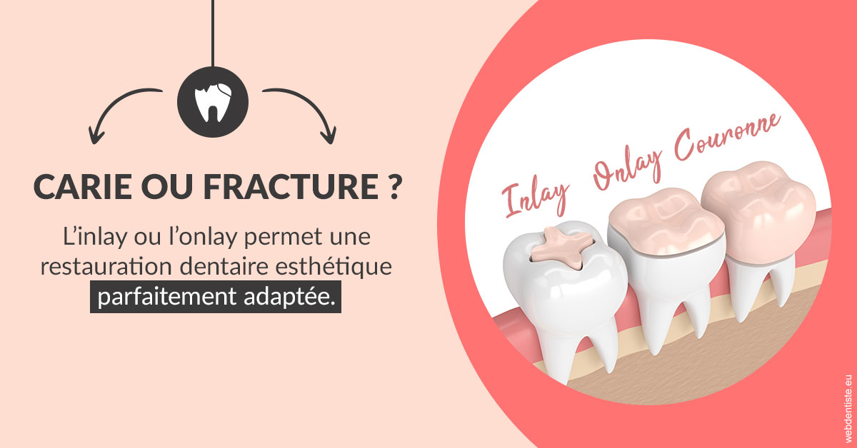 https://dr-hassid-jacques.chirurgiens-dentistes.fr/T2 2023 - Carie ou fracture 2