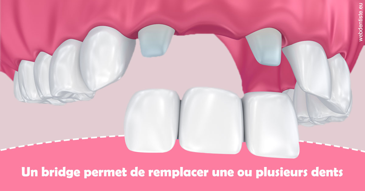 https://dr-hassid-jacques.chirurgiens-dentistes.fr/Bridge remplacer dents 2