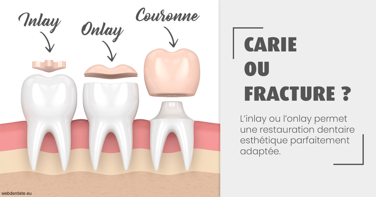 https://dr-hassid-jacques.chirurgiens-dentistes.fr/T2 2023 - Carie ou fracture 1