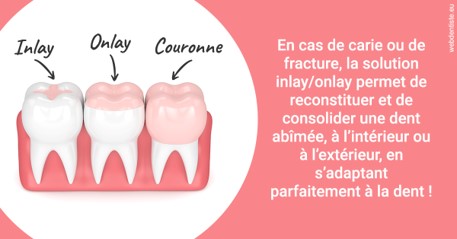 https://dr-hassid-jacques.chirurgiens-dentistes.fr/L'INLAY ou l'ONLAY 2