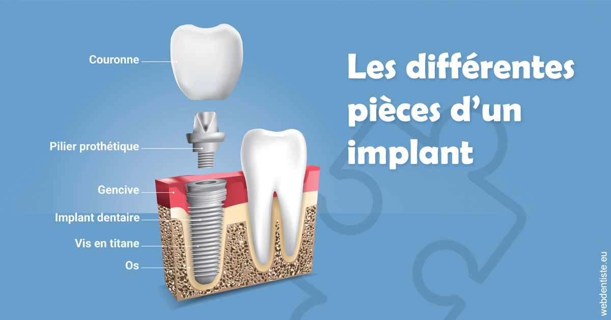https://dr-hassid-jacques.chirurgiens-dentistes.fr/Les différentes pièces d’un implant 1