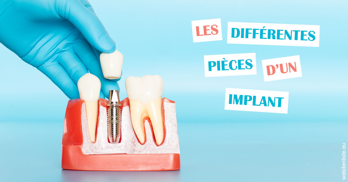 https://dr-hassid-jacques.chirurgiens-dentistes.fr/Les différentes pièces d’un implant 2